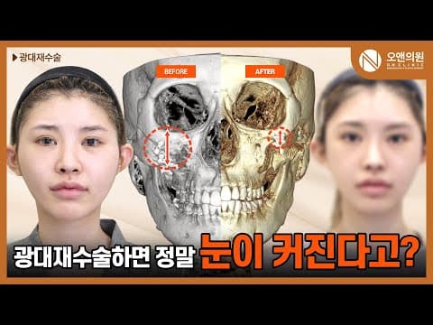 颧骨修复手术：做修复真的能让眼睛变大吗？