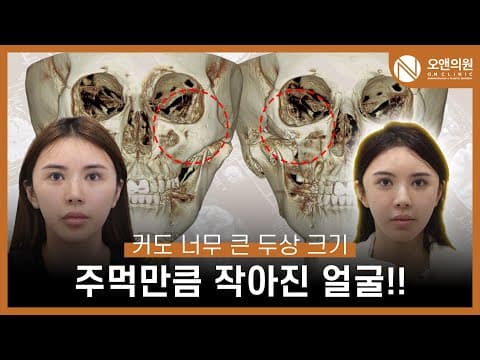 광대중안면축소수술: 주먹만큼 작아진 얼굴, 커도 너무 큰 두상
