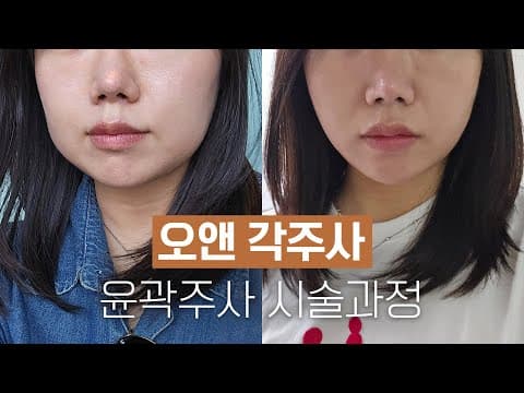 O.N Clinic facial contouring injection: procedure and effects at a glance