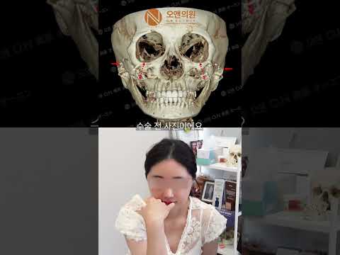 颧骨再手术：矫正骨不愈合及不对称，第三次颧骨手术