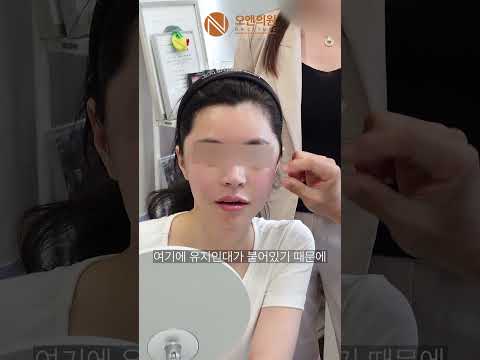 안면윤곽 3종 후 볼처짐 재수술 | 뼈를 올리면 피부도 따라 올라갑니다