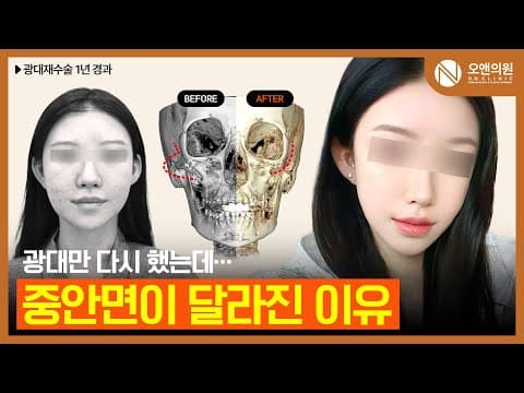 광대뼈 재수술 후 얼굴 길이와 두상 변화: 1년 경과 후기