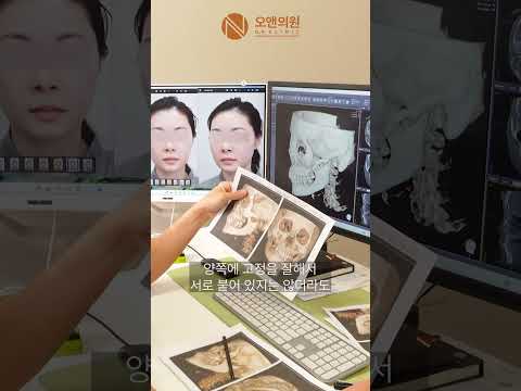 Long-Untreated Zygomatic Fracture Restored by Dr. Oh Myung-jun, 16,000 Cases