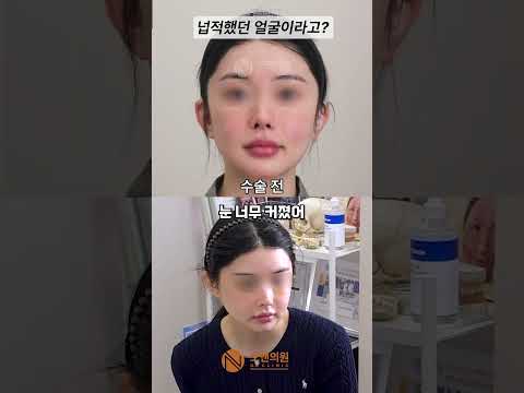 扁平的脸变小变美的秘诀？削骨后依然显宽的原因