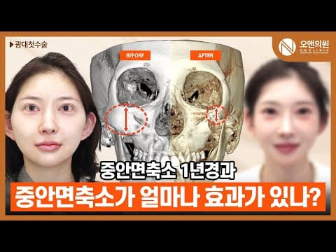 On Clinic轮廓 颧骨中面部缩小：术后1年效果