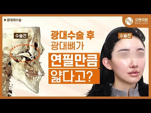 오앤 안면윤곽 광대중안면축소수술: 광대뼈가 연필만큼 얇아진 사례
