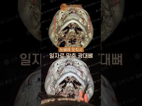 Achieving a Smaller, Clearer Face Through Zygoma Asymmetry Correction