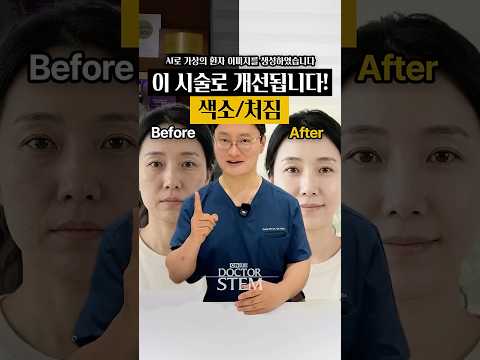 늘어난 색소 침착, 피부결 저하,팔자 주름 때문에 고민이신가요? 🕰️