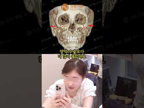 안면윤곽 3주차 환자, 눈 커지고 비대칭 개선에 감탄