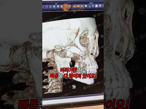 광대뼈 재수술: 30개 고정핀과 벌어진 뼈틈 해결