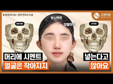 颧骨中面部缩小手术：就算往头里灌水泥，脸也不会变小