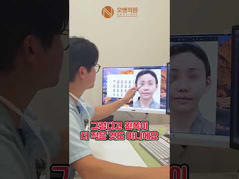 재수술로 11시간 광대뼈 재건, 뼈이식으로 안전하고 단단하게 복원