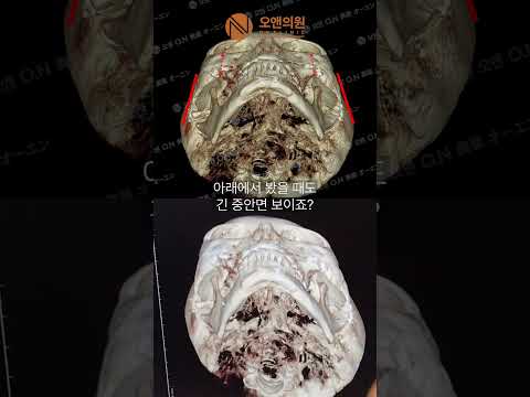 긴 중안면과 광대 비대칭 개선 수술: 세로로 긴 얼굴 솔루션