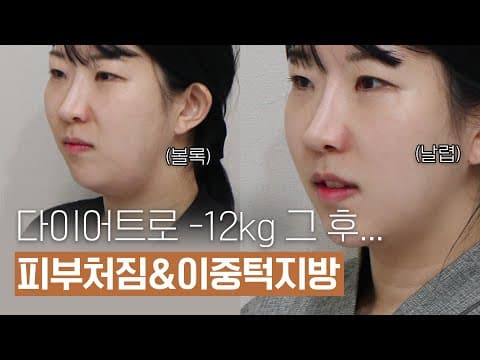 ON Contour Injection: Fixing Lost Volume and Sagging After Weight Loss