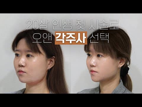 ON Contour Injection, First Time Ever: Double Chin Solution Chosen at 20