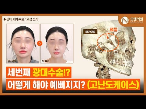 광대 재수술: 30대 후반 세 번째 수술 고난도 케이스