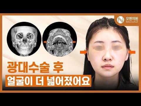 颧骨中面部缩小术：手术后脸反而变宽的案例