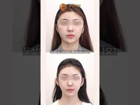 Zygoma Reduction Before and After 3cm Reduction and Head Size Reduction