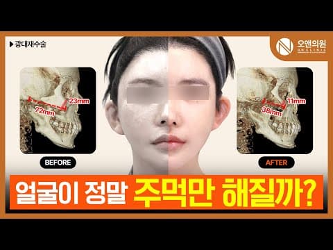 Revisional Zygoma Surgery 3-Month Update: My Face Shrank to a Fist Size