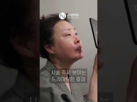 50多岁的皮肤烦恼：用钛提升一并解决下垂和皱纹