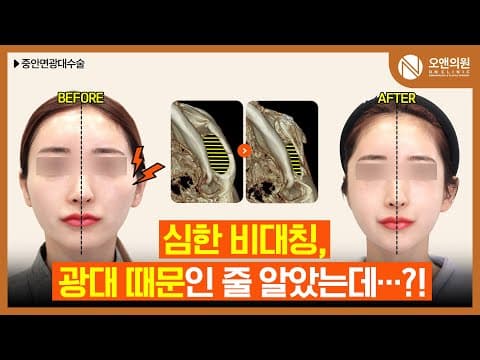 중안면광대수술: 안면윤곽수술 후 얼굴이 더 커보이고 길어보이는 이유