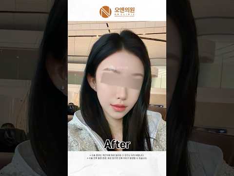 再手术后变小的脸与埋线提升副作用护理：1年经过实录