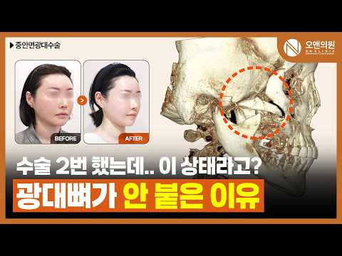 颧骨再手术：骨不连导致骨骼完全分离患者的戏剧性变化