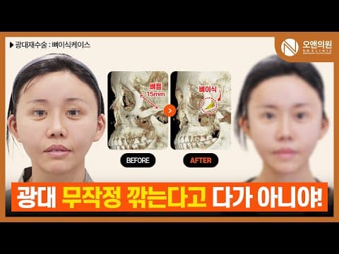 Zygoma Reoperation: Repairing a Bone Gap From Excessive Shaving With Bone Graft