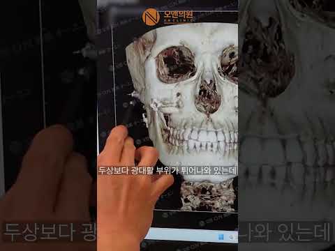 광대 재수술: 계단 현상 해결 및 얼굴 입체감 개선