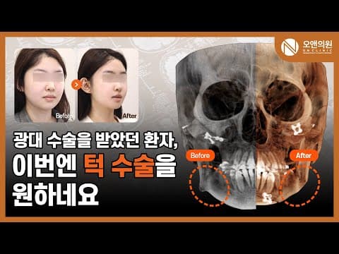 오앤 안면윤곽 V-라인 수술 후기: 광대 후 V라인 추가 사례