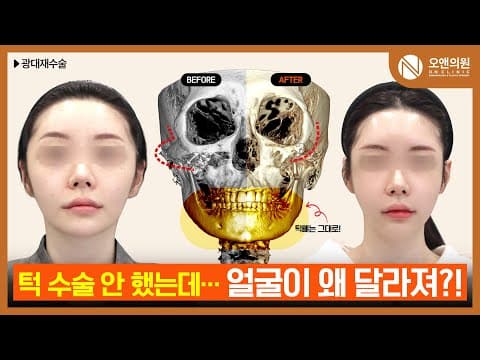 颧骨修复手术后脸部比例变化与印象改善：无需下巴手术也焕变