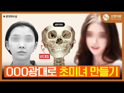 ON Clinic Zygoma Asymmetry Correction and Reduction Surgery: Patient Review