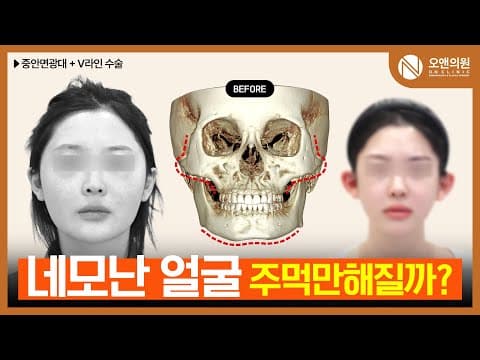 オーアン顔面輪郭 中顔面頬骨縮小＋Vライン：四角い顔が拳に？