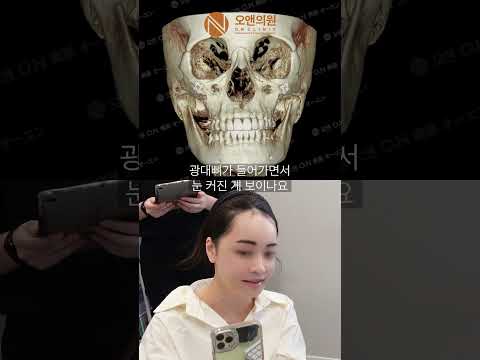 颧骨不对称矫正让眼睛显得更大，颧骨首次手术体验回顾