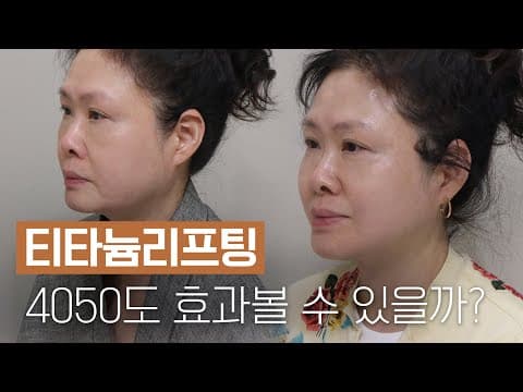 40岁50岁人群也能见效的钛提升术后真实心得
