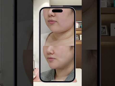 On Clinic塑身与轮廓术前后对比：成功预约美丽