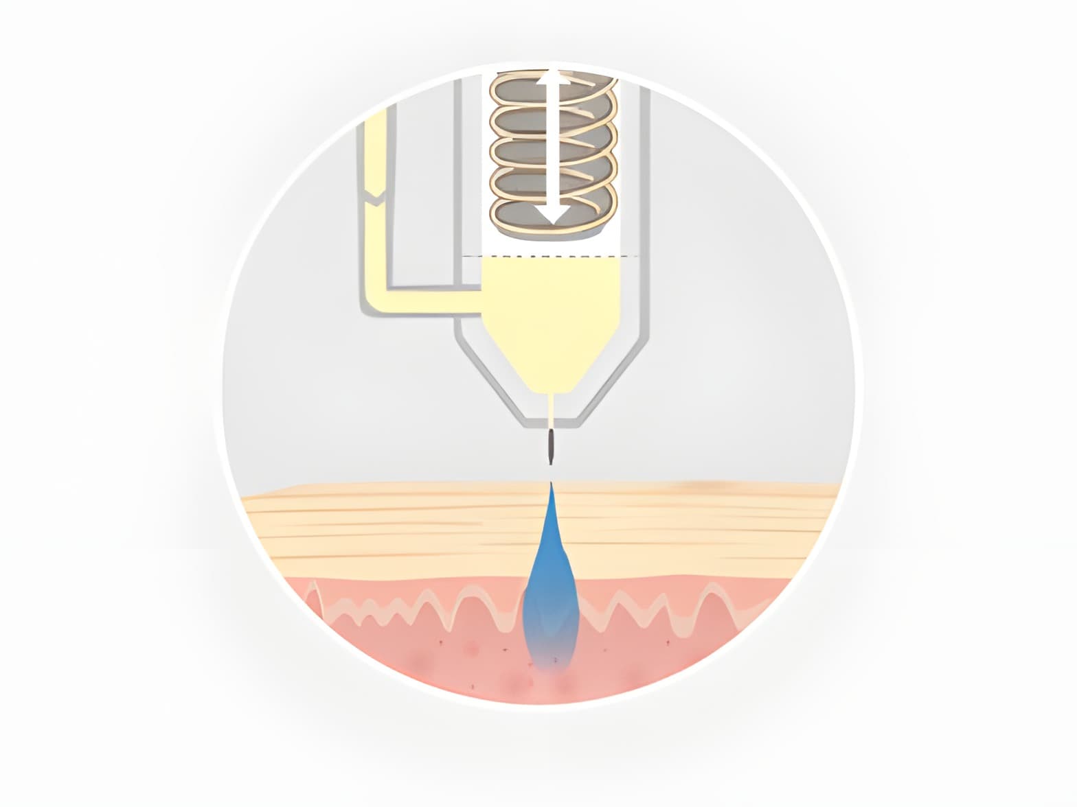 STEP 03: マイクロジェット噴射
