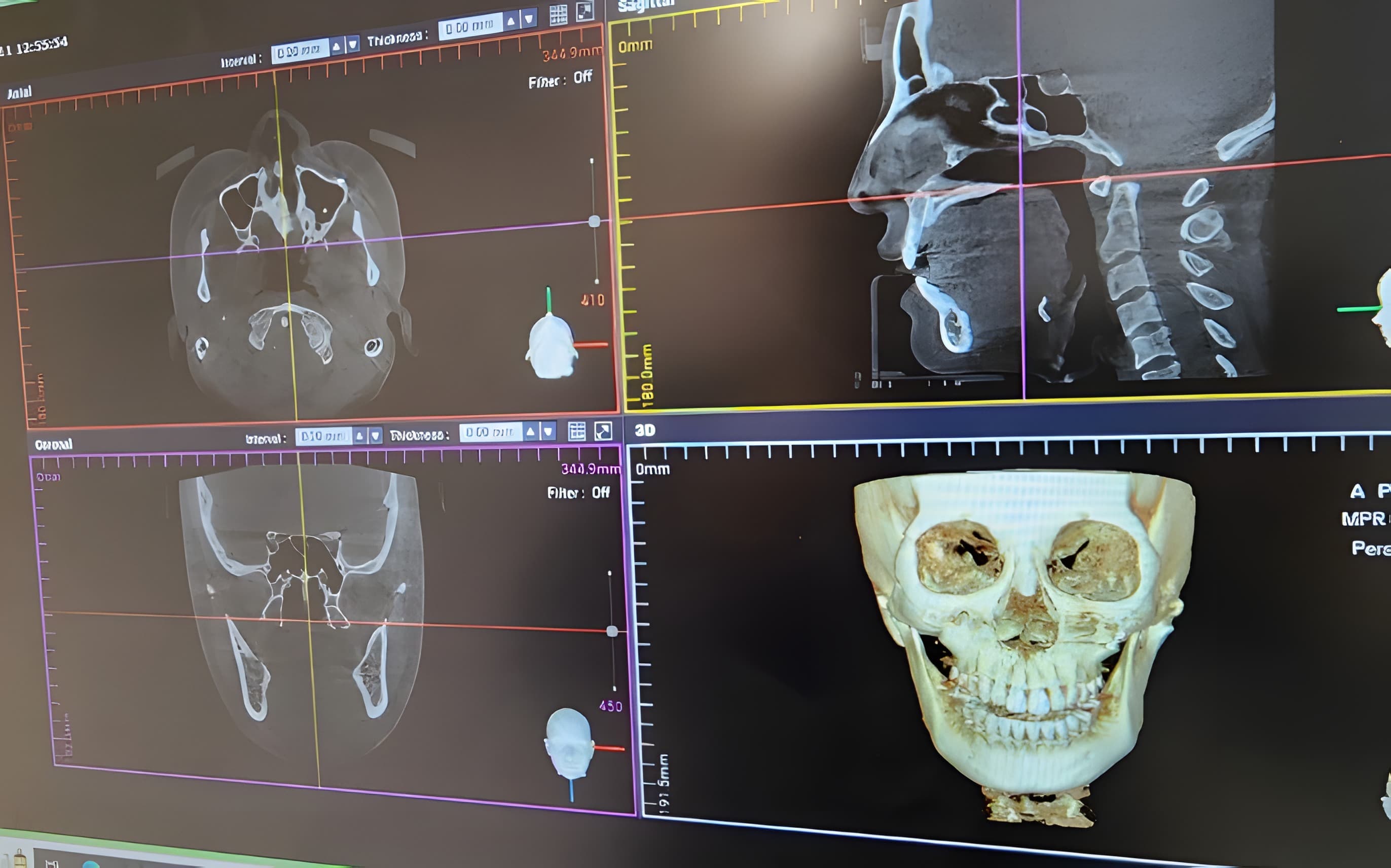 CT-Proven Stable Surgical Results