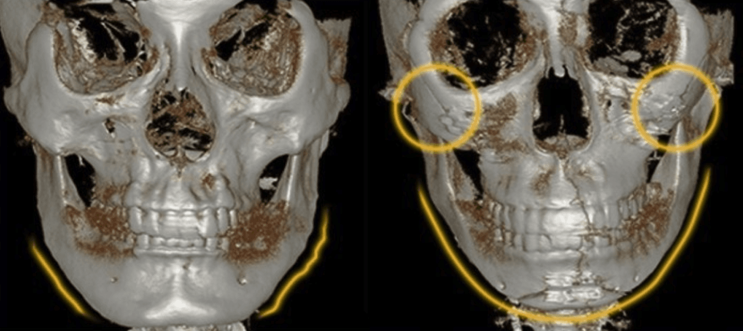 CASE 01: Bumpy jaw line with reduced front balance after square-jaw surgery