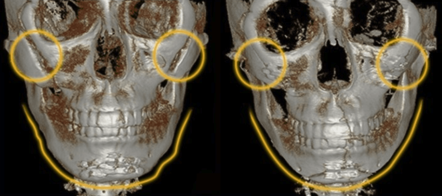 CASE 02: Cheekbone non-union and dissatisfaction after quick-cheek surgery, revised