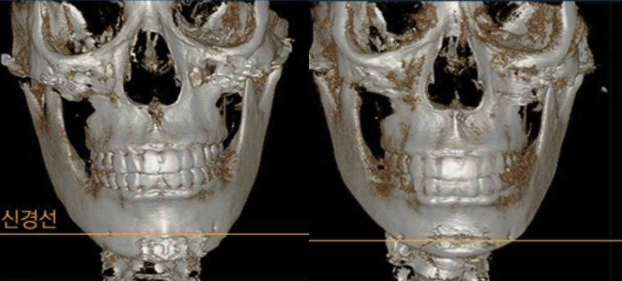 CASE 03: A case where revision surgery was deemed difficult by multiple hospitals.