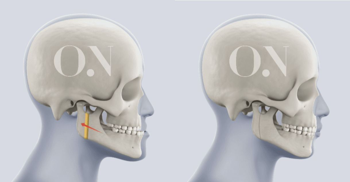 IVRO (Intraoral Vertical Ramus Osteotomy) Case