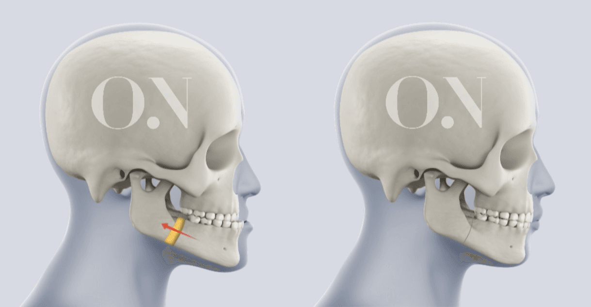 SSRO (Sagittal Split Ramus Osteotomy) Case