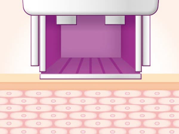 STEP 01: Treatment Tip Placement