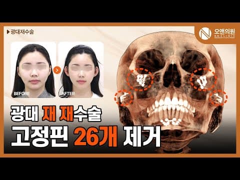 오앤 안면윤곽 광대재수술: 고정핀 26개 제거와 뼈이식 사례