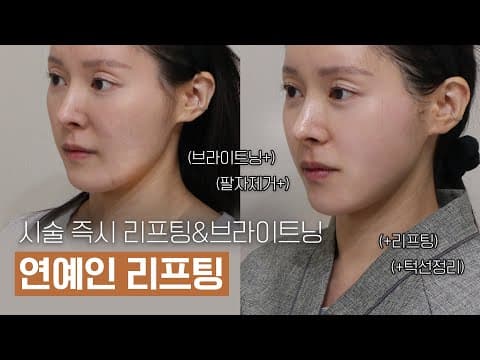 奥恩诊所钛提升:明星青睐的即时提升与亮肤效果