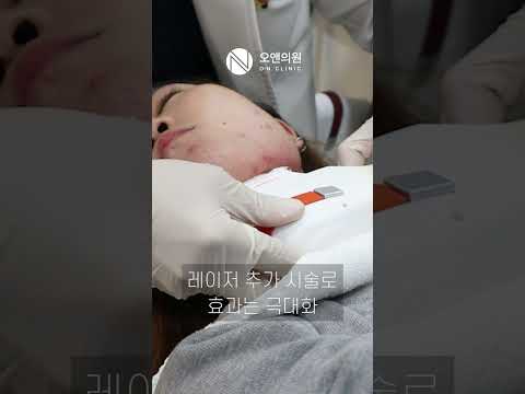 Age 20, First Procedure Ever: Why I Chose O.N Contour Injection