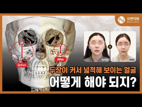 Zygoma and Midface Reduction: A Solution for a Wide Face From a Large Head