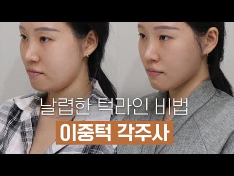 Double Chin Contour Injection Review: Achieving a V-Line with a Laser Booster