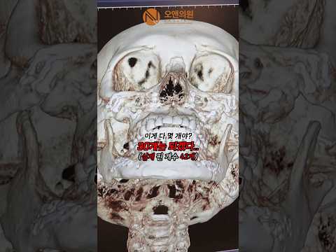 42 Bones? A Perfect Result After Removing Bone Callus for a Smaller Face